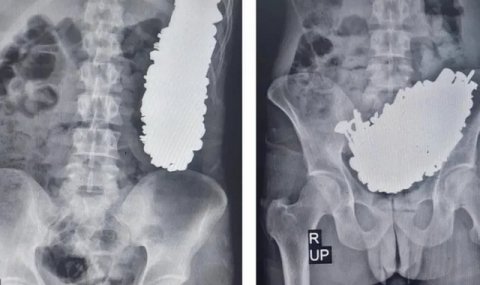В Иране врачи выявили 452 металлических предмета в желудке мужчины